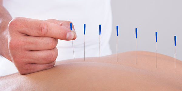 acupuncture in back